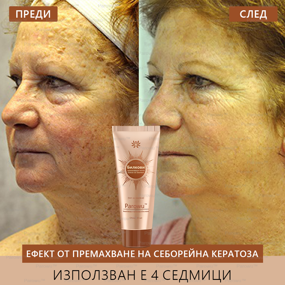 💟Parowu™ Изсветляваща и премахваща петна маска - 🍃Натурални съставки за дълготрайно премахване на петна, хиперпигментации и слънчеви петна